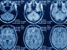 Pacientes con glioblastoma se ven obligados a costear su tratamiento por falta de acceso, denuncia Astuce