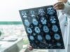 ASTUCE Spain pide garantizar acceso a tratamientos para el oligodendroglioma