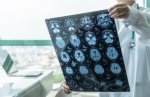 ASTUCE Spain pide garantizar acceso a tratamientos para el oligodendroglioma