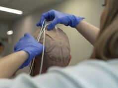 El hospital 12 de Octubre en Madrid participa en ensayo fase 3 sobre tratamiento combinado del glioblastoma