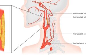 Una estenosis en las arterias carótidas puede avanzar sin síntomas hasta provocar un ictus