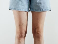Piernas hinchadas tras el verano: cuándo las varices deben llevarnos al médico
