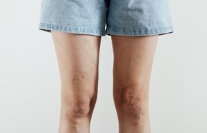 Piernas hinchadas tras el verano: cuándo las varices deben llevarnos al médico