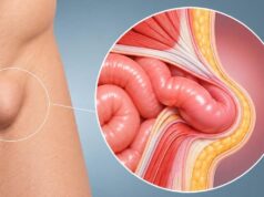 Cirugía de hernia sin hospitalización: los pacientes que pueden volver a casa el mismo día