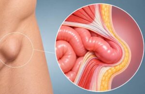 Cirugía de hernia sin hospitalización: los pacientes que pueden volver a casa el mismo día